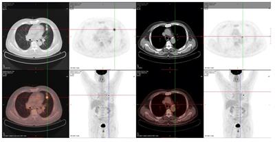 Case report: Response to Savolitinib/EGFR-TKI combination in NSCLC patients harboring concurrent primary MET amplification/overexpression and EGFR mutation